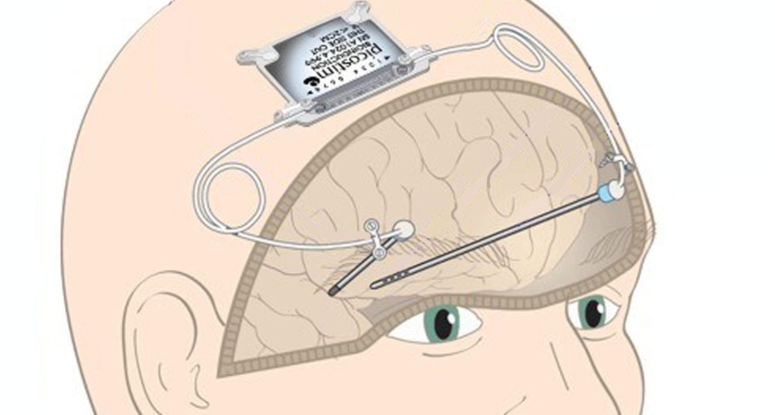Bioelectronic Medicines