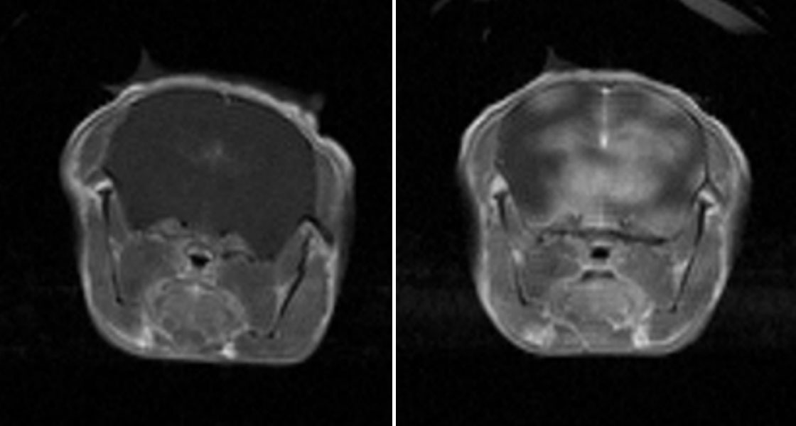 Blood Brain Barrier Disruption