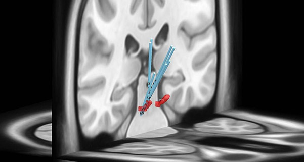 Brain Stimulation for Better Sleep