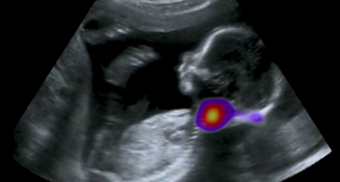 Fetal Ultrasound Analysis