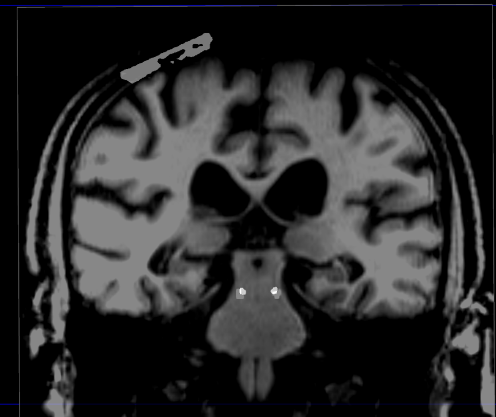 MotIoN aDaptive Deep Brain Stimulation for MSA (MINDS)