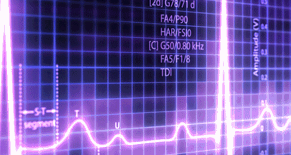 AI-Predicted Heart Arrythmia